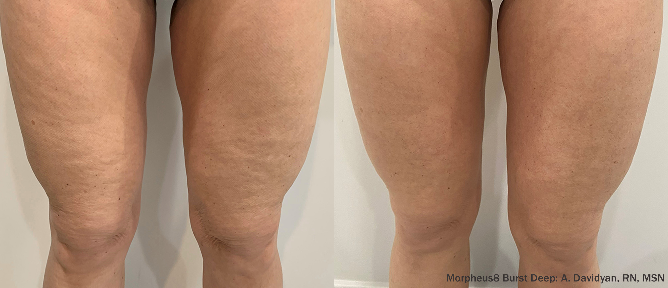 LA Beauty Skin Center_M8BD_Thighs_3Months-TM