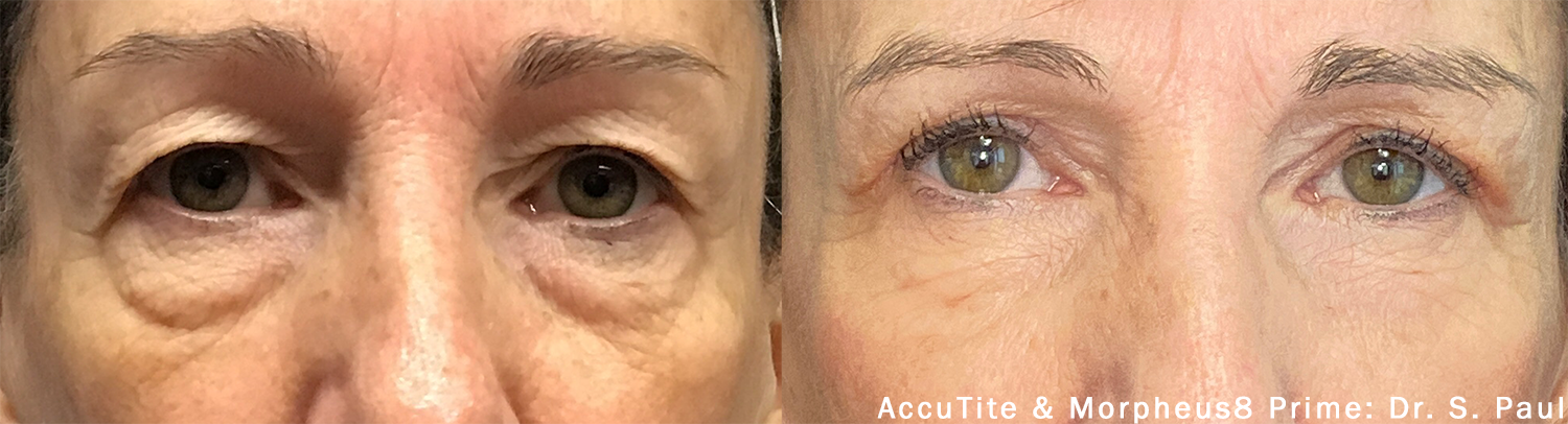 accutite-morpheus-prime-before-after-dr-s-paul-preview-1.png