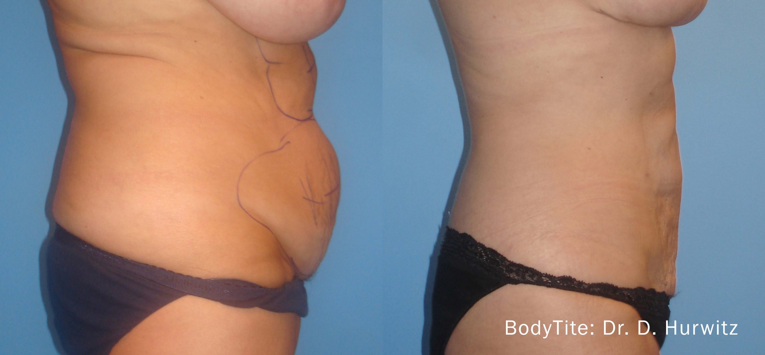 bodytite-before-after-dr-d-hurwitz-preview-2.jpg