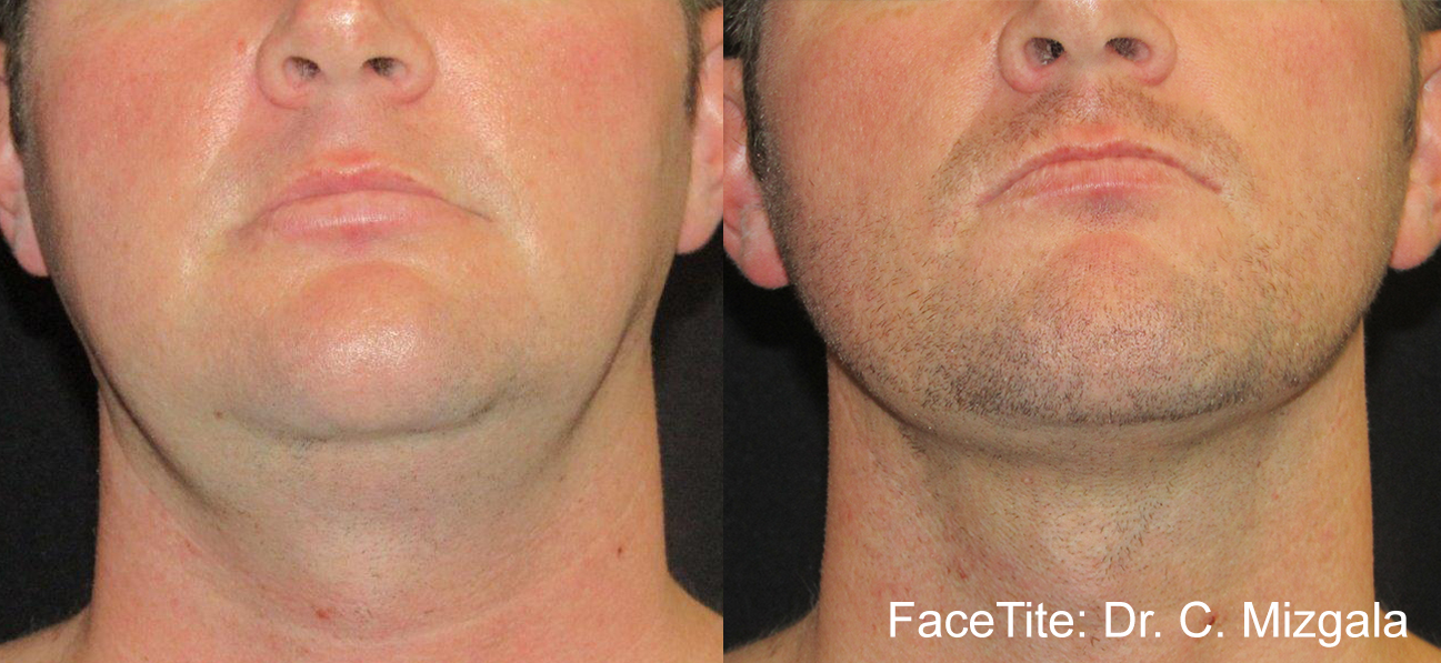 facetite-before-after-dr-c-mizgala-preview-1-1.jpg