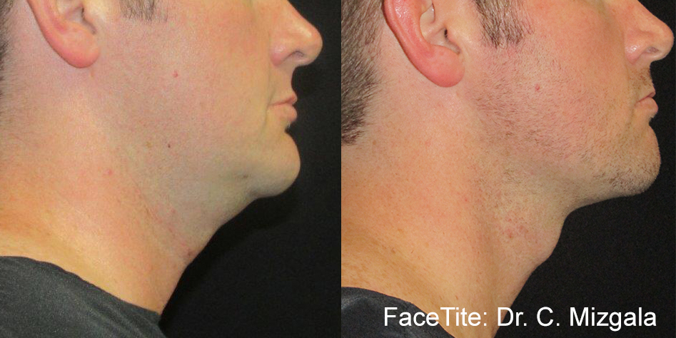 facetite-before-after-dr-c-mizgala-preview-2-1.jpg