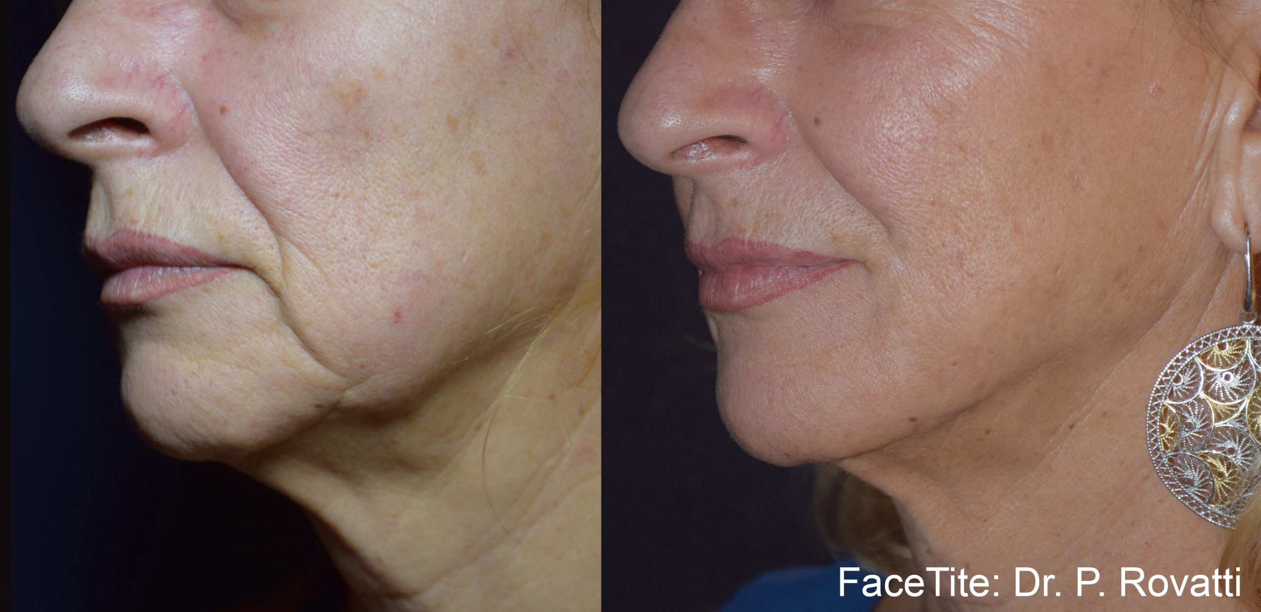 facetite-before-after-dr-p-rovatti-preview-2-1.jpg