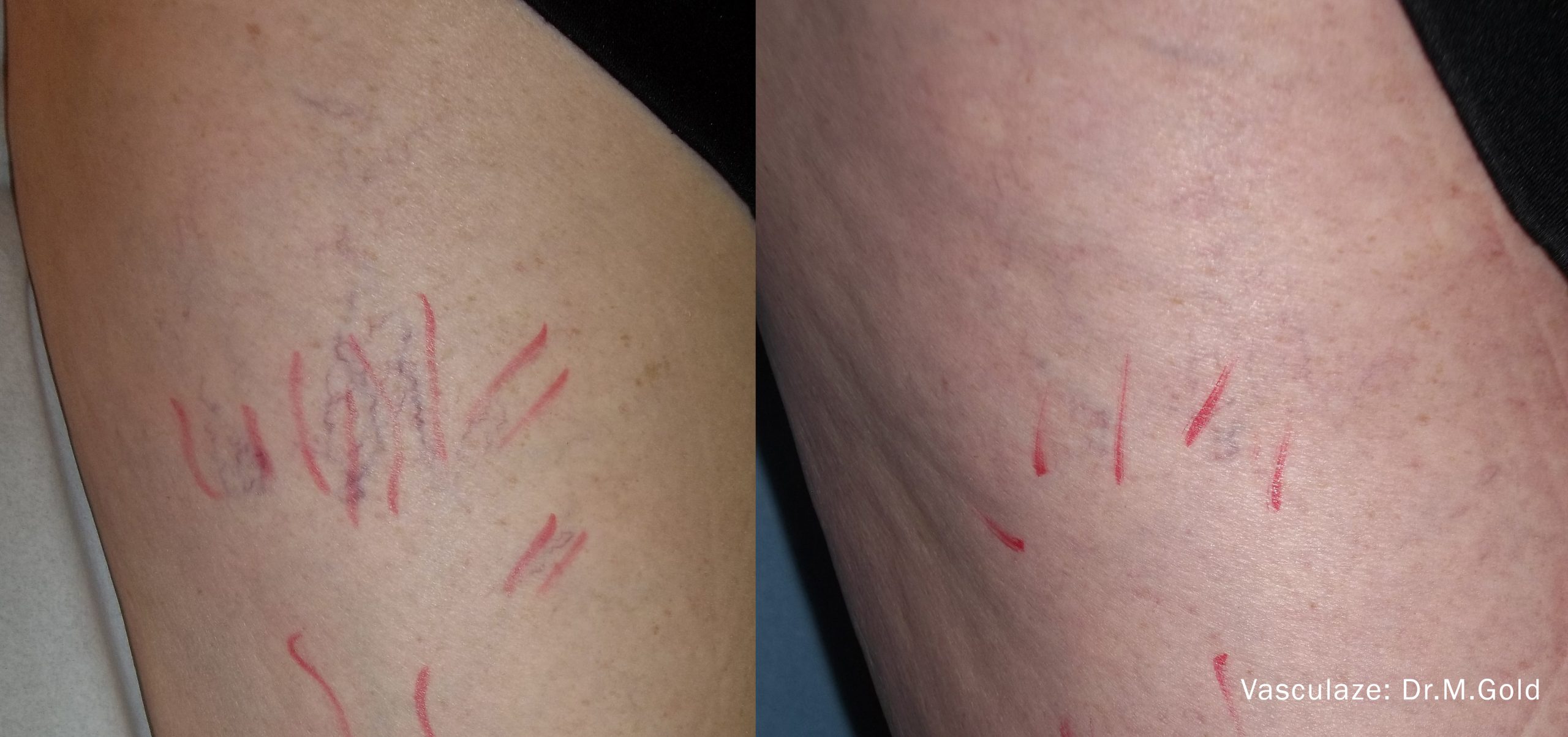 vasculaze-before-after-dr-h-goren-preview-1