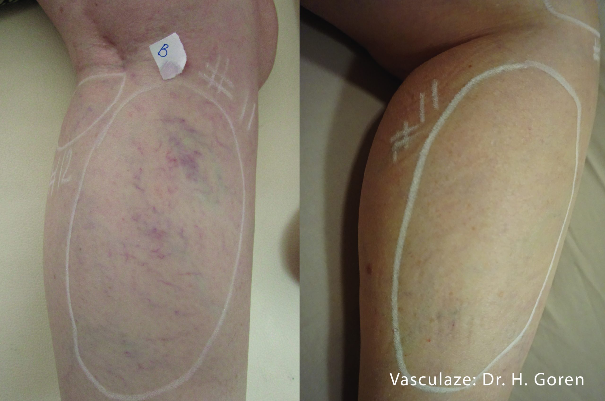 vasculaze-before-after-dr-h-goren-preview-2