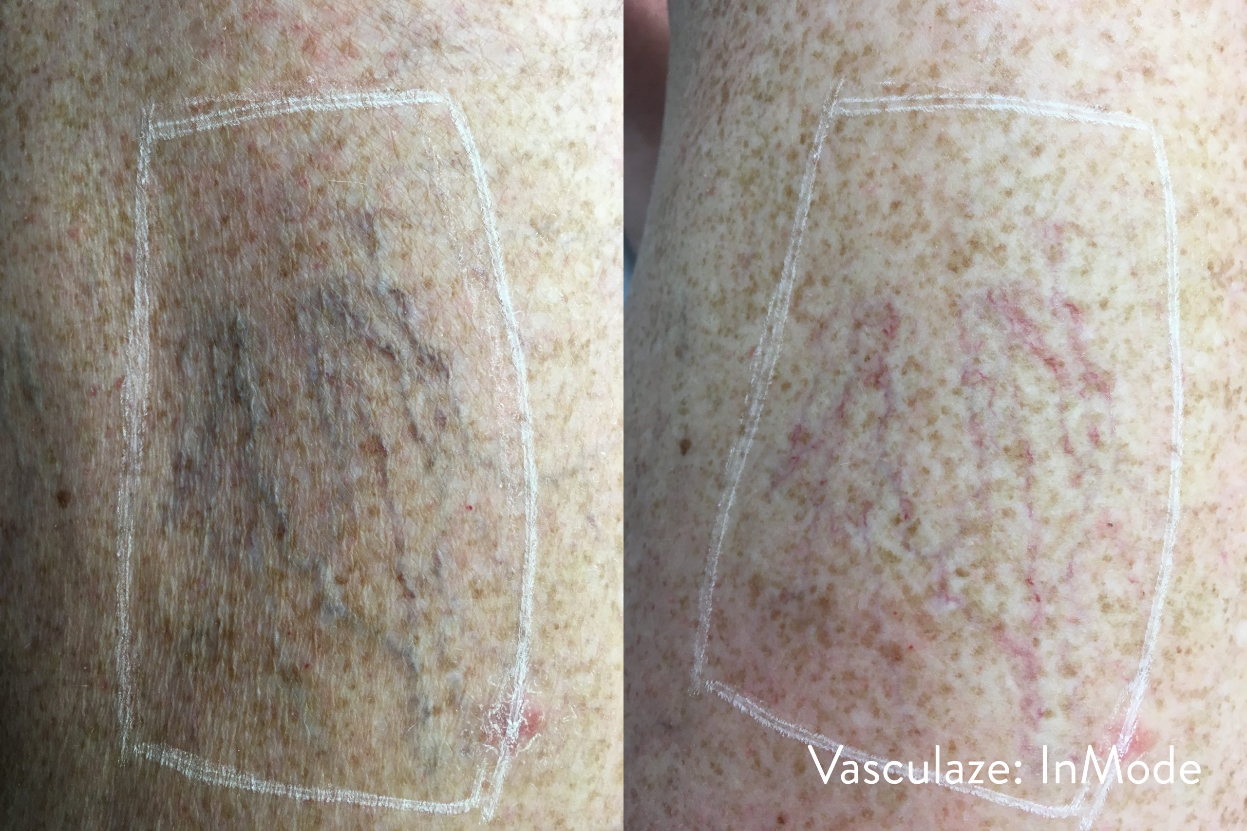 vasculaze-before-after-inmode-preview-1